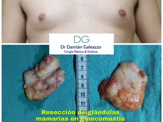 Ginecomastia resección glándulas 
