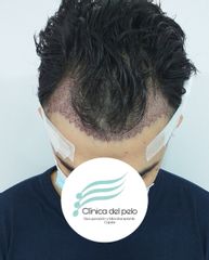 Implante Capilar recién  finalizado - Dr. Damián Galeazzo