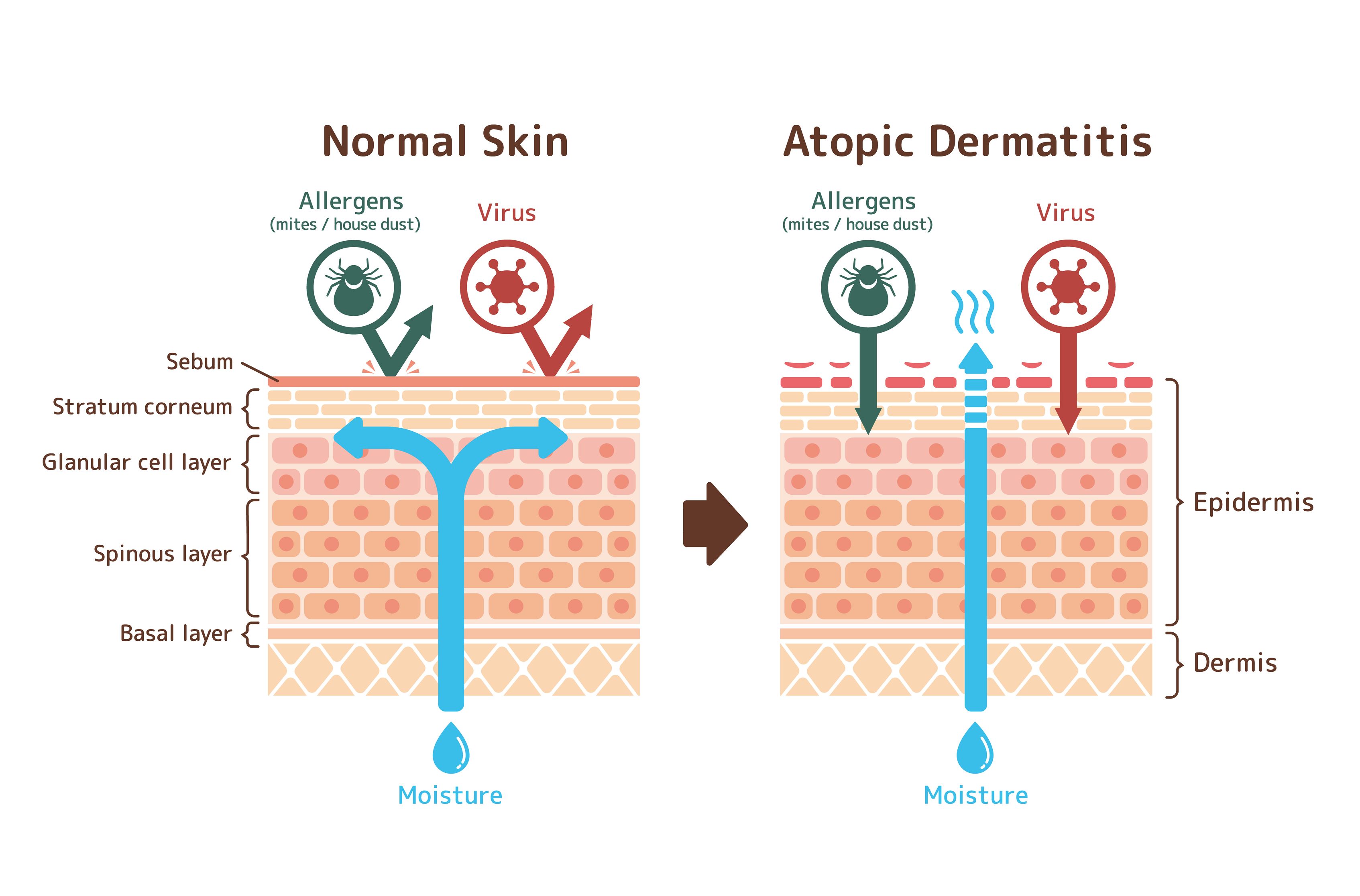 Como a dermatite atua na pele