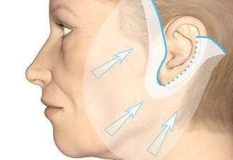Cirurgia facial