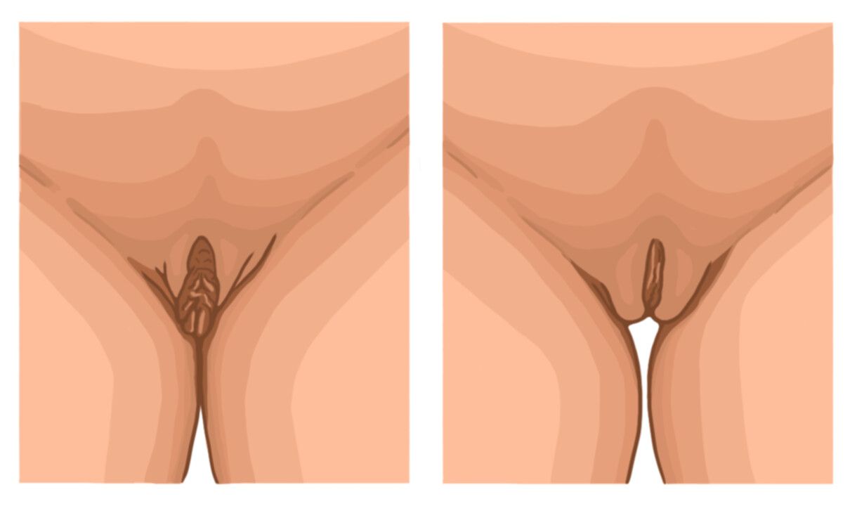 Antes e depois da labiaplastia