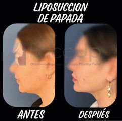 Cirugía de papada - Face Up Puebla