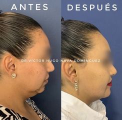Cirugía de papada - Face Up Puebla Dr. Víctor Hugo Nava Dominguez