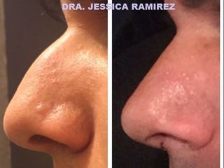 Antes y después de Cirugía de nariz