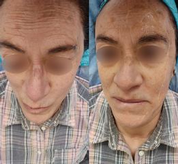Antes y después de Tratamientos faciales 