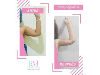 Antes y después de Braquioplastia