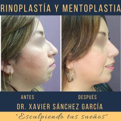 Antes y después de Rinoplastia y mentoplastia