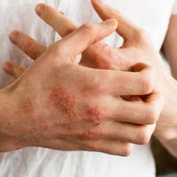 Há quantos tipos de dermatite?
