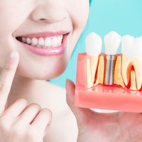 O que são os implantes dentários de carga imediata?