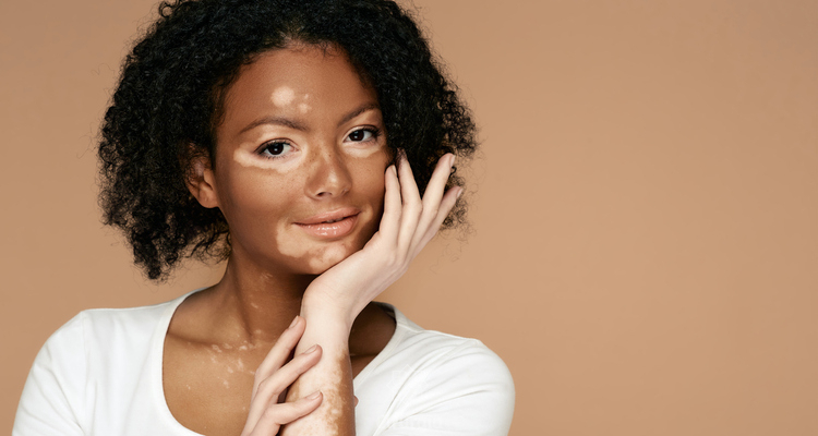 O que fazer quando se tem vitiligo