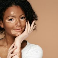 O que fazer quando se tem vitiligo