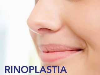 Rinoplastia