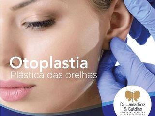 Otoplastia