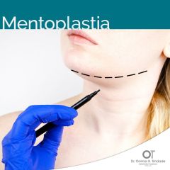 Mentoplastia