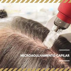 Microagulhamento capilar