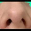 Narinas assimétricas, nariz desviado, como funciona o procedimento?
