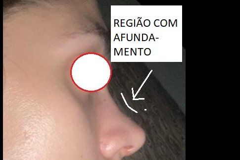 Rinoplastia com afundamento região da cartilagem septal superior - 32320