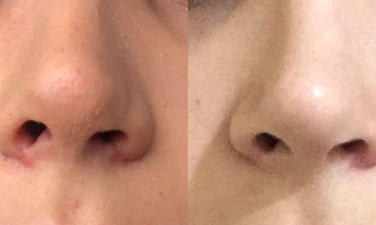 É normal ficar com a narina assimétrica mesmo após 5 meses de rinoplastia? - 48045