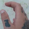 Remoção de tatuagem nos dedos com cirugia