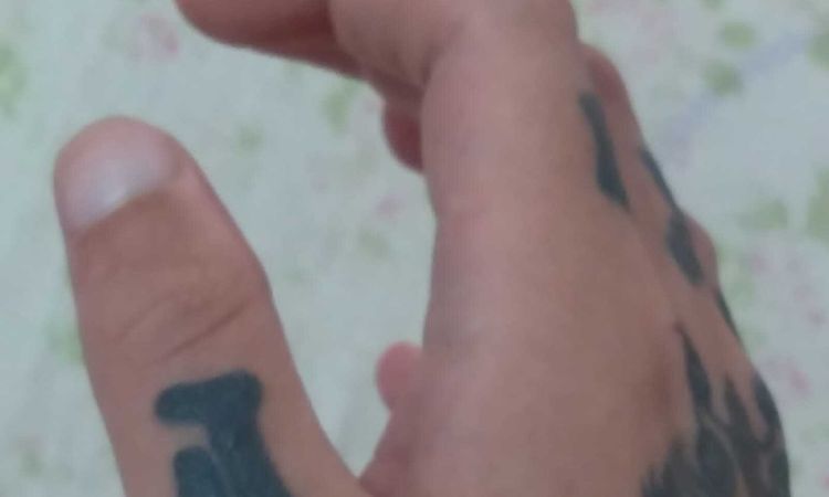 Remoção de tatuagem nos dedos com cirugia - 60184