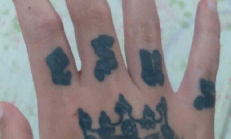 Remoção de tatuagem nos dedos com cirugia - 60185