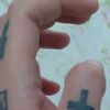 Remoção de tatuagem nos dedos com cirugia - 60186