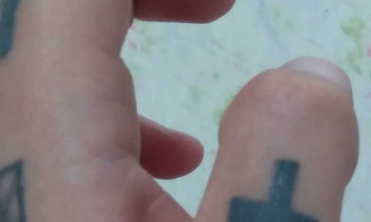 Remoção de tatuagem nos dedos com cirugia - 60186