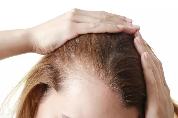 Mosaic Ho™ é adequado para o tratamento da alopecia