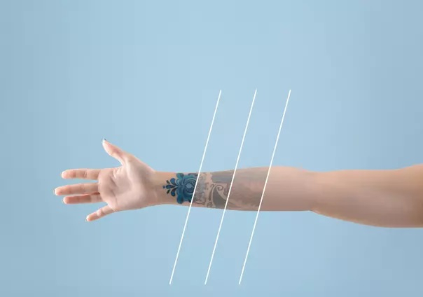 Laser indicado para remover tatuagens
