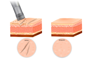 Ação do microagulhamento na pele.