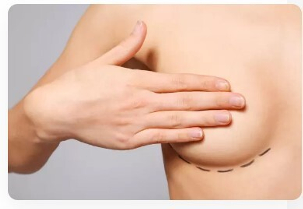 A mamoplastia de aumento pode ser realizada ao mesmo tempo que a cirurgia de resignação de gênero ou durante a fase de tratamento hormonal