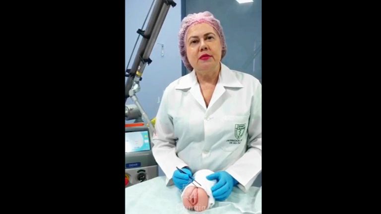 Como é realizada a Ninfoplastia - Dra Laura Guimarães