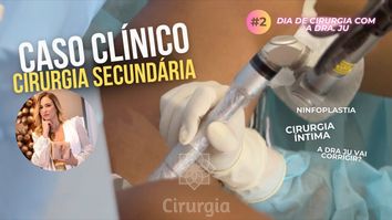 TEM COMO CORRIGIR CIRURGIA ÍNTIMA? Cirurgia Secundária – Dra. Juliana Moreira