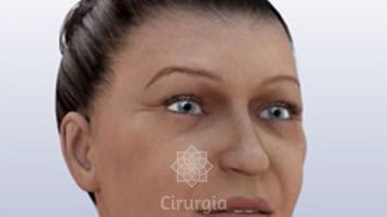 Como acontece o lifting facial?!