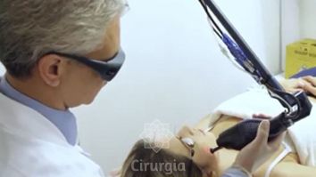 Tratamento de Cicatriz de Acne e Cirúrgica com Laser de C02 Fracionado