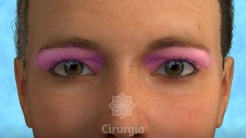 Blefaroplastia, como funciona?