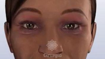 Blefaroplastia (Cirurgia das Pálpebras)