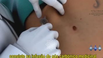 Carboxiterapia