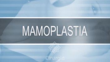 Mamoplastia - Dr. Adson Andrade de Figuerêdo