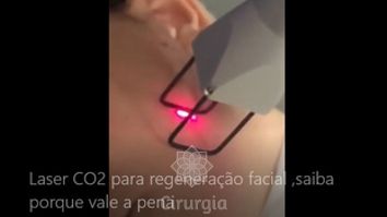 As máquinas da beleza! Laser CO2