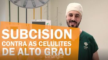 Subcision: contra as celulites de alto grau