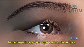 Tudo o que você precisa saber: Blefaroplastia!