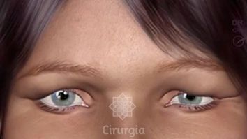 Blefaroplastia